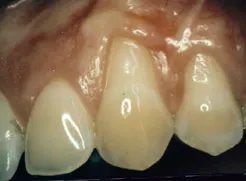 Gum grafting before