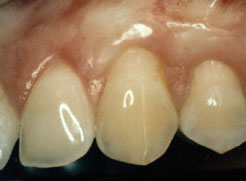 Gum grafting after